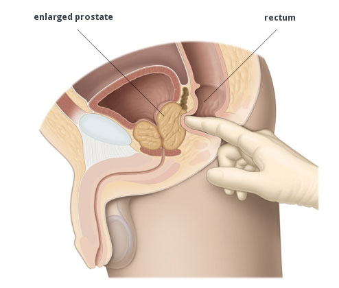 IPB ipertrofia prostatica benigna