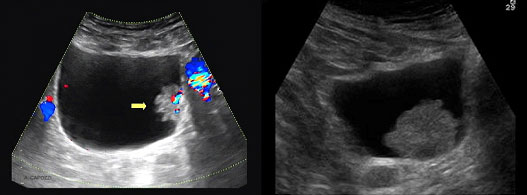 papilloma vescicale tac