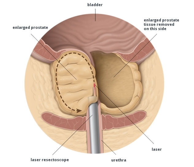 enucleazione prostata