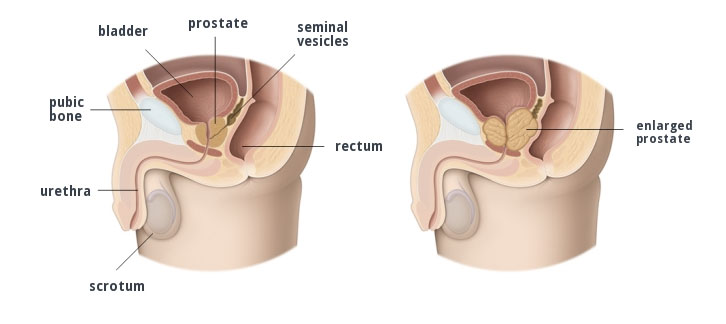 IPB ipertrofia prostatica benigna