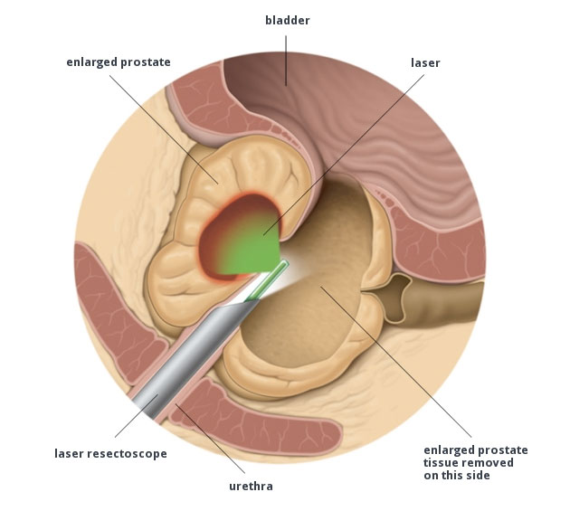 dimensioni prostata preoccupante