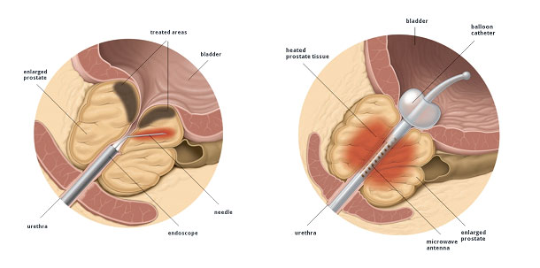 IPB ipertrofia prostatica benigna