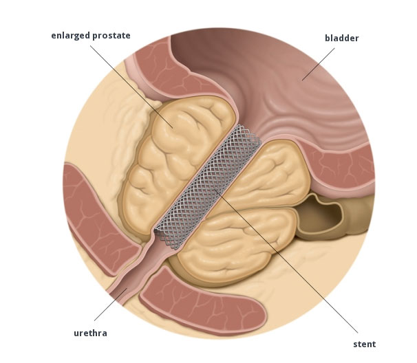 IPB ipertrofia prostatica benigna