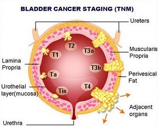 rectal cancer lower back pain